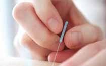 放血療法靠譜嗎 中醫(yī)和西醫(yī)放血療法有什么區(qū)別