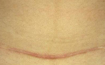 結(jié)扎和上環(huán)哪個(gè)對(duì)身體影響小 上環(huán)后可以喝酒嗎