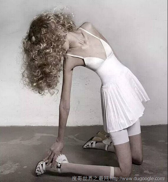 世界最瘦的人,只有22公斤的女孩Ariel 世界最瘦的人,只有22公斤的女孩Ariel